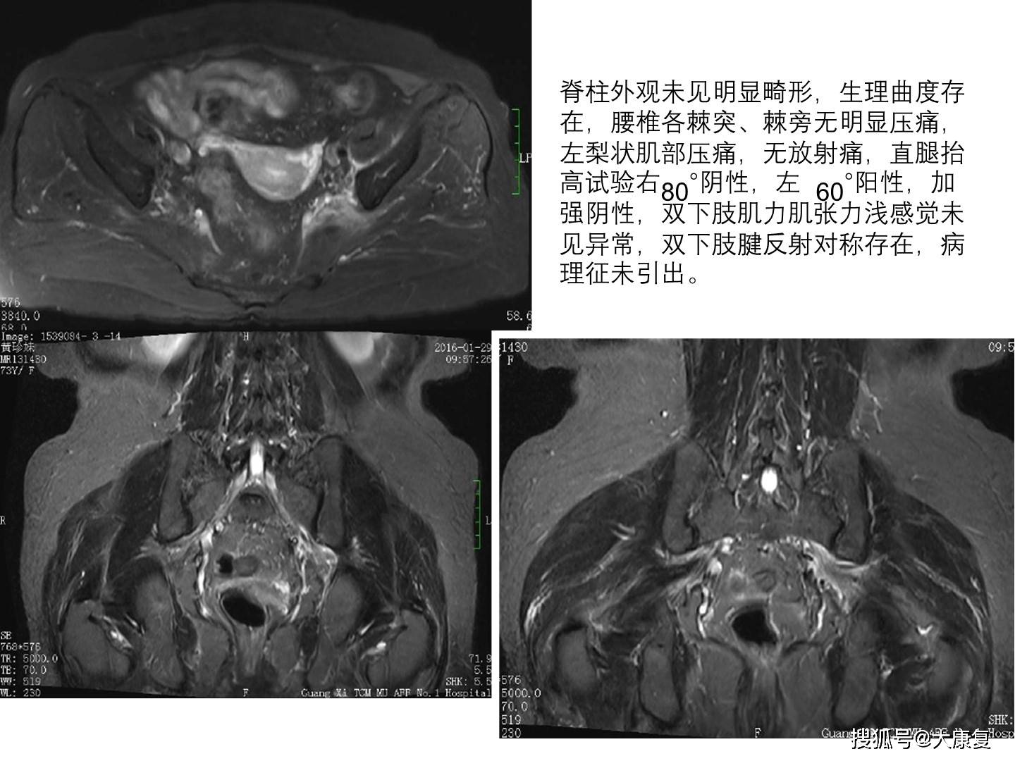 mr在梨状肌综合征诊断中应用