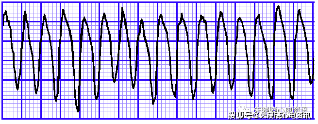 心室扑动与颤动及濒死性心律失常