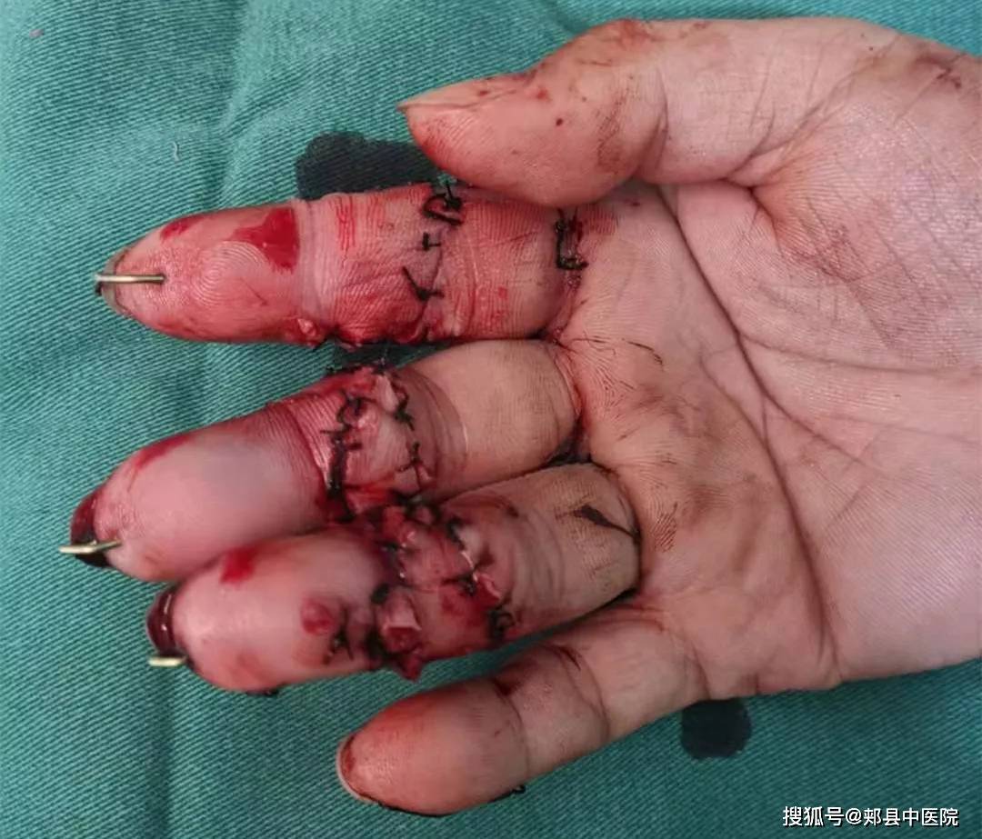 郭俊召实施断指(肢)再植手术后待康复的患者手指
