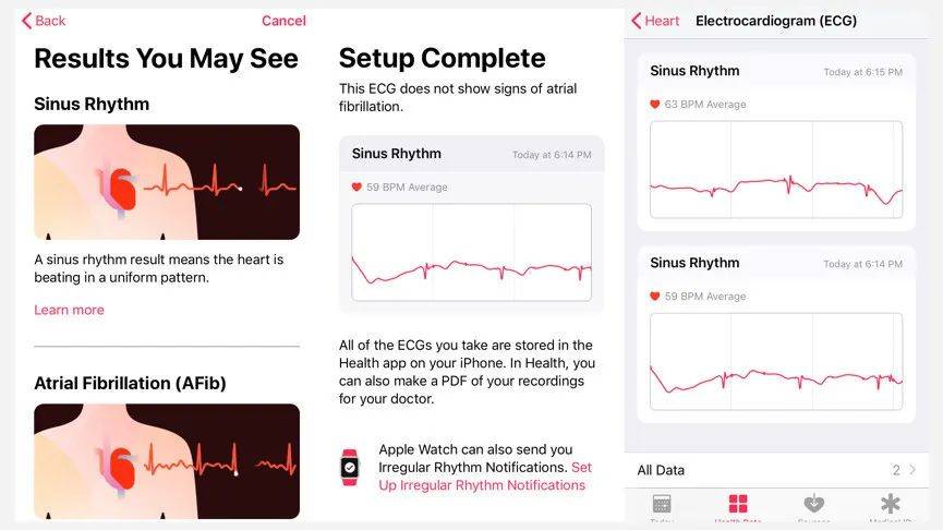 问题|苹果侵犯心电专利，Fitbit硬件出问题，三星、华为一波三折，ECG 手表怎么了？