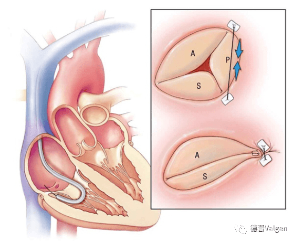 三尖瓣治疗技术介绍