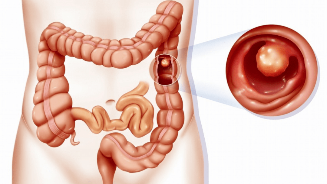 肠息肉切了就可以高枕无忧了吗?注意:以下症状提示息肉"蠢蠢欲动"!