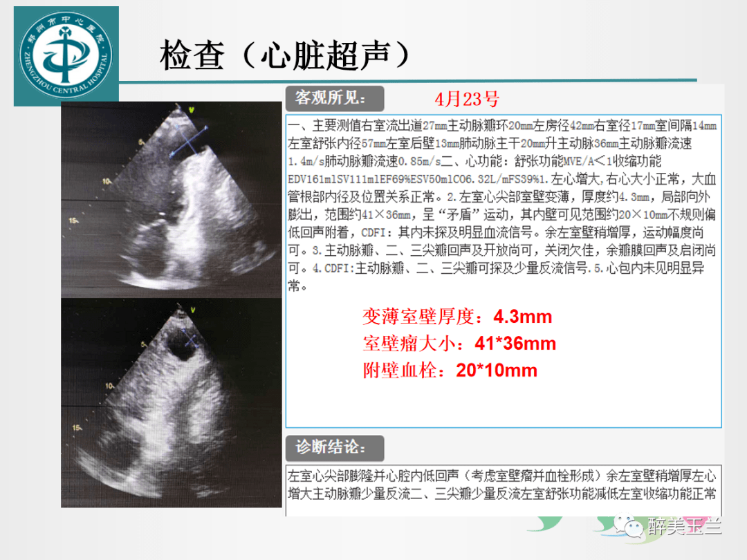 心室壁瘤合并附壁血栓患者的麻醉