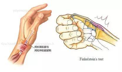 finkelstein"s test:把拇指紧握在其他四指内,手腕偏向小指侧,桡骨