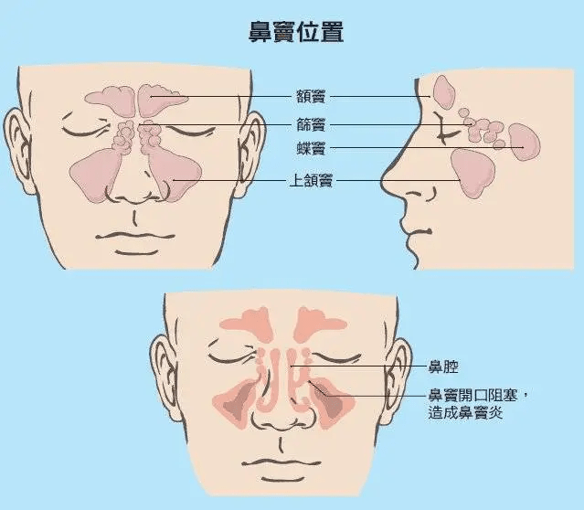 清鼻堂科普鼻窦炎高发久治不愈的危害你不会不知道吧