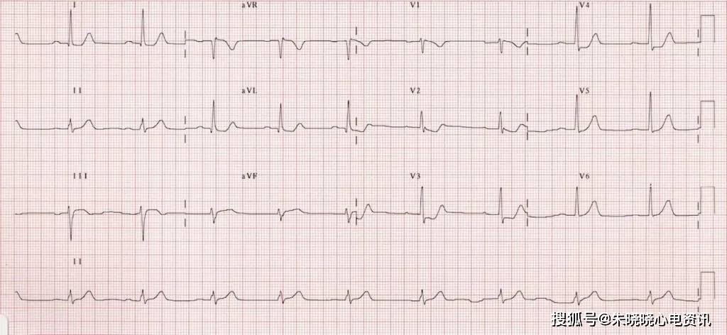 心肌缺血的心电图表现