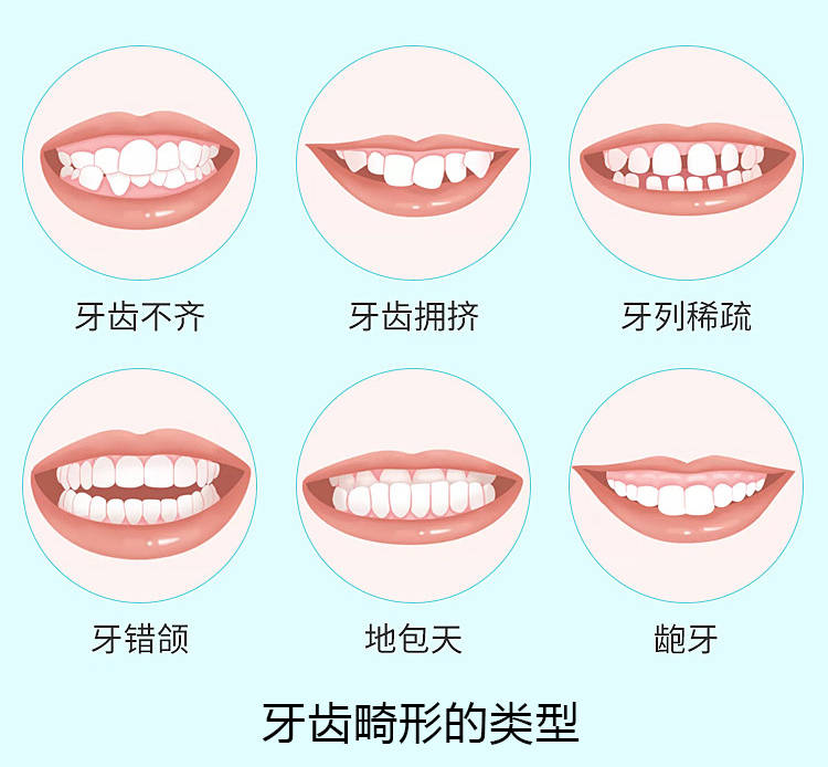 牙齿畸形怎么办牙齿畸形的危害有哪些