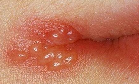 如果嘴唇上长的是簇集性水泡(如下图),那很有可能是唇疱疹.