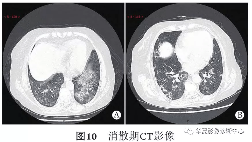 影像进展新冠肺炎的ct典型和不典型表现以及影像学分期