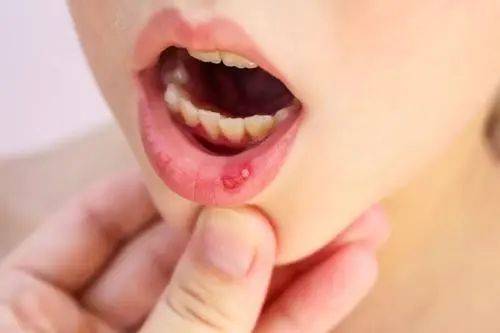口腔溃疡,又称为"口疮",是一种慢性的炎症性疾病,是发生在口腔粘膜上