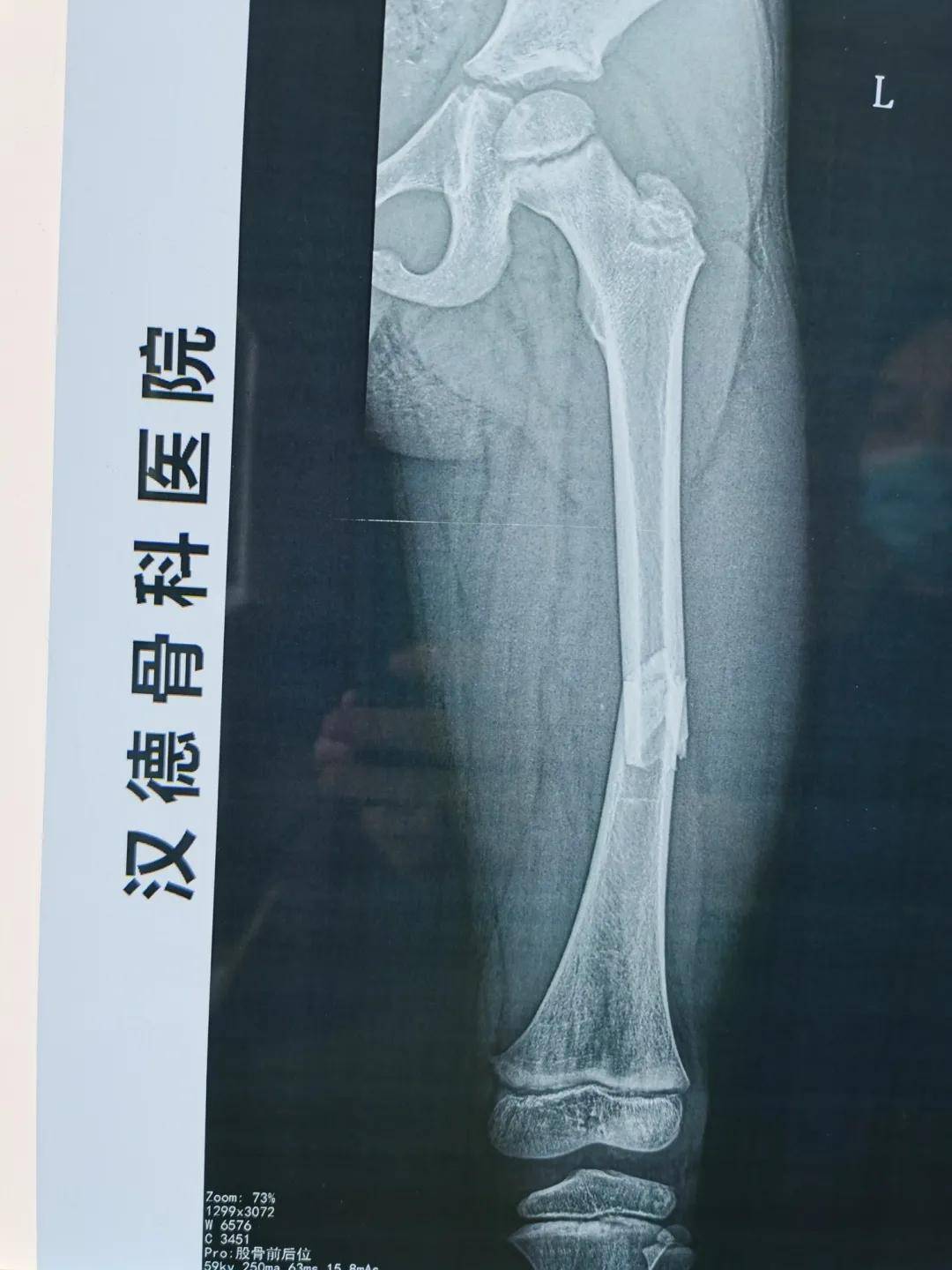弹性髓内针 手术前,x光影像中明显的大腿的骨折 手术中的c形臂透视