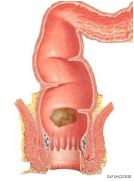 危险的"痔疮"—直肠癌