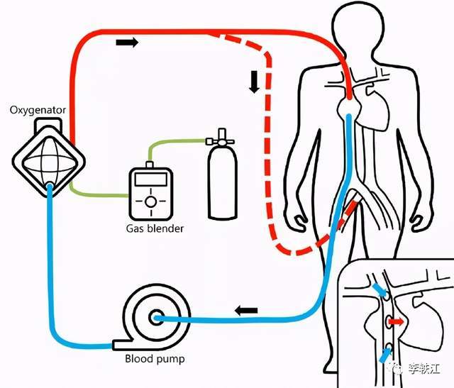 心系生命,向着重生,救命神器"ecmo!