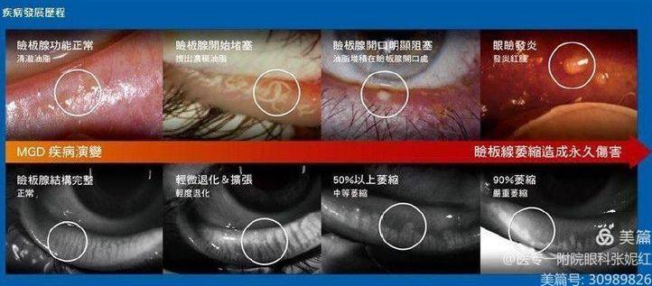 眼睛干涩快查查你的睑板腺南阳医专一附院眼科