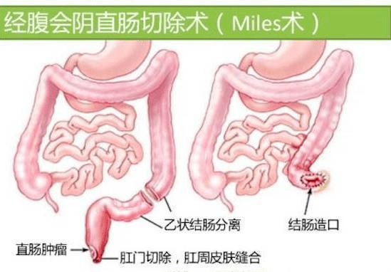 第二种是不保留肛门的手术,即腹会阴直肠癌联合切除术(miles手术).