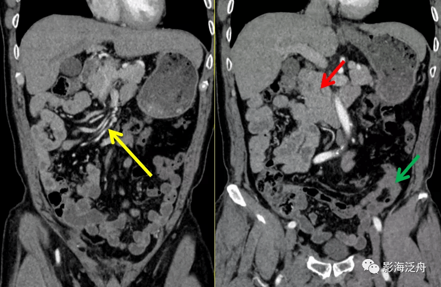 这个病,腹部ct经常会漏诊!