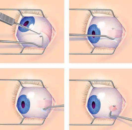 眼科医生札记:斜视手术方案该如何设计?