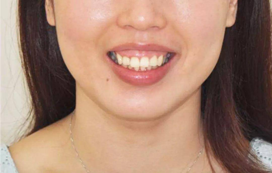 其次,上前牙萌出障碍,导致牙龈包裹部分牙冠,牙冠相对短小,微笑时露出