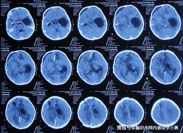 男童脑室引流和内镜术后颅内感染性孤立颞角(脑积水)