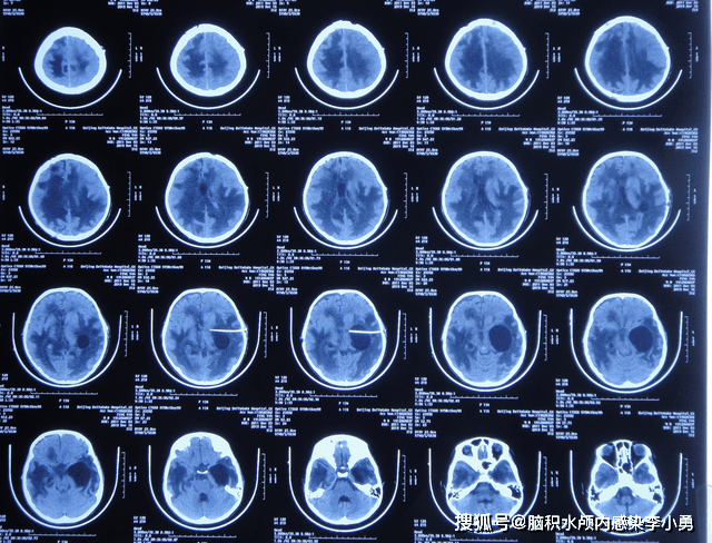 图-21:头颅ct(2019年12月16日)2019年12月18日即入李小勇脑脊液中心第