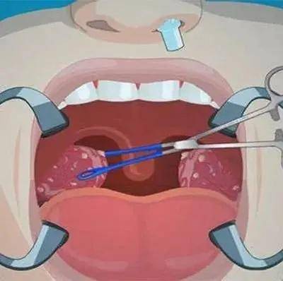 嗓子疼,张不开嘴,吃药没效果,这是怎么了?