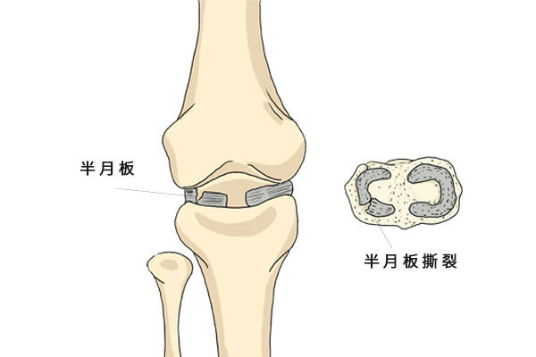 半月板撕裂后,少走路,多休息就能自行愈合?如何护理半月板?