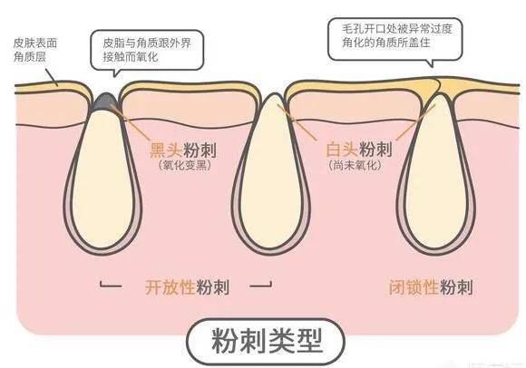 额头长黑头怎么办