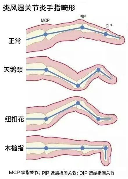 血管翳形成,并逐渐出现关节软骨和骨破坏,最终导致关节畸形和功能丧失