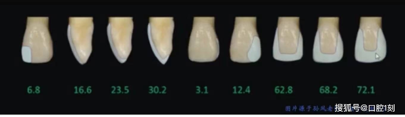 美学修复牙体预备要领(四)之贴面的分类预备
