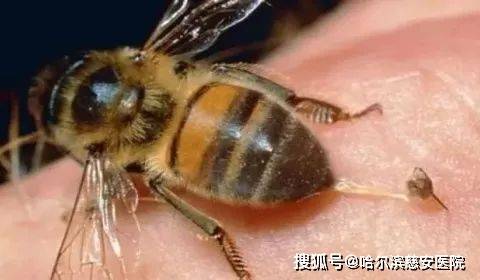 单个蜜蜂蛰伤很少引起全身症状,仅有轻微局部症状,无需特殊处理.