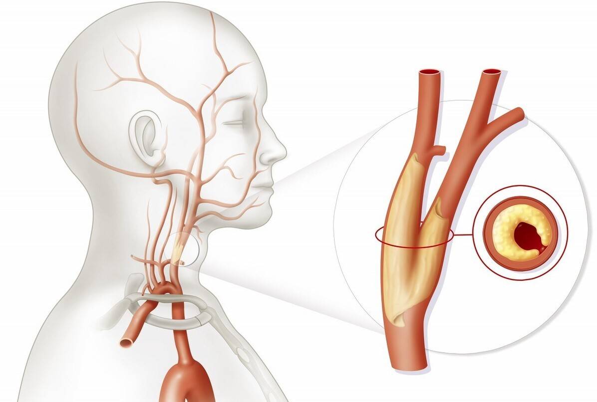 颈动脉的斑块可以逆转吗?可以,但要看斑块是