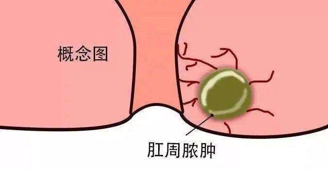 肛周脓肿怎么引起的?_肛门