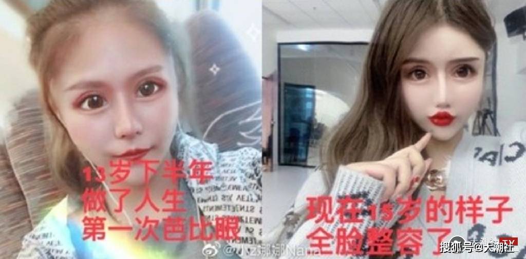 「小z娜娜」13岁就狂整容,自揭3年内整100次,超400万人民币.