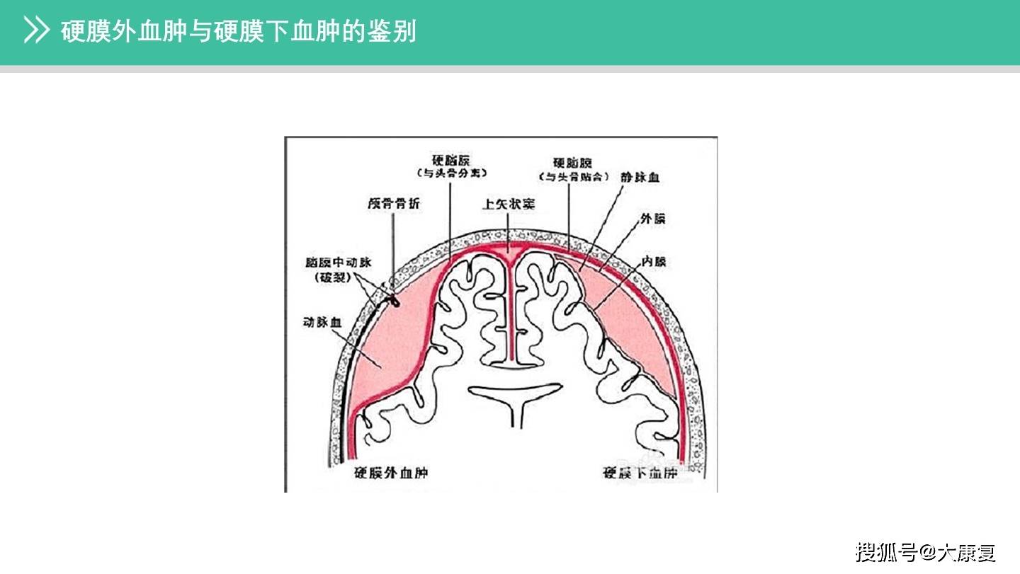 硬膜外血肿与硬膜下血肿的鉴别]