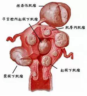 子宫肌瘤不用急介入治疗帮助您