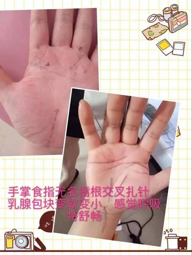 特效乳腺针法九针变式藏针放血