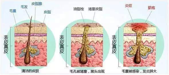 脸上的黑头粉刺如何才能彻底去除