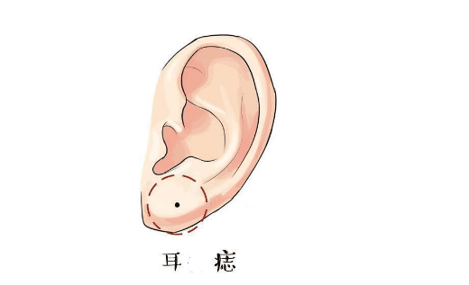 耳朵长有活痣耳朵在面相中为福气的象征,若是一个人的耳朵上长有活痣