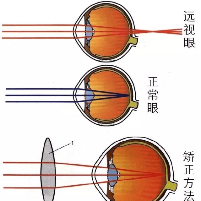 近视眼是指看近处清楚而看远处不清楚的一种病理状态.