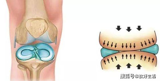 膝关节半月板损伤如何处理?肽好生活告诉你!