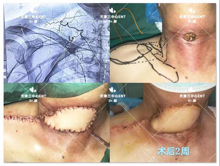 三中心耳鼻喉头颈外科成功为喉癌患者修复复杂颈前缺损_手术