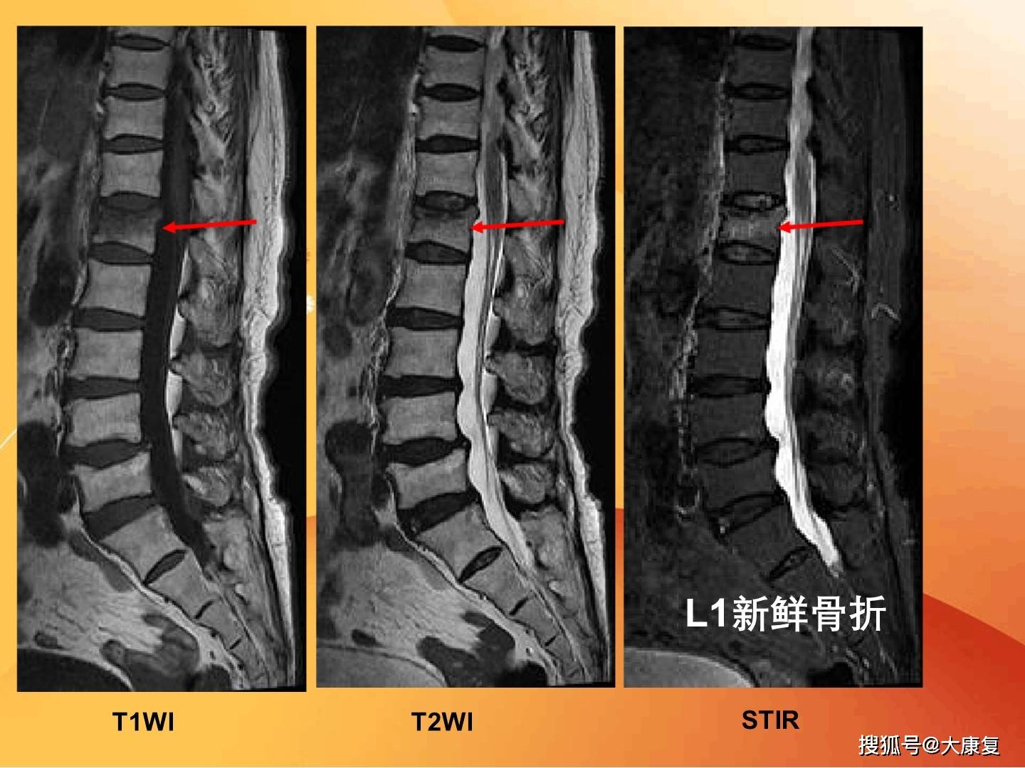 脊柱常见疾病的mri诊断