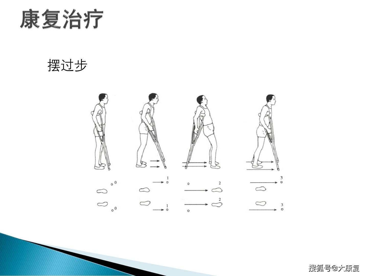 脊髓损伤的步行功能训练