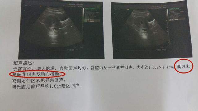 在怀孕60天(也就是两个月)以前就能检测到胎心,这是胎儿的原始心管