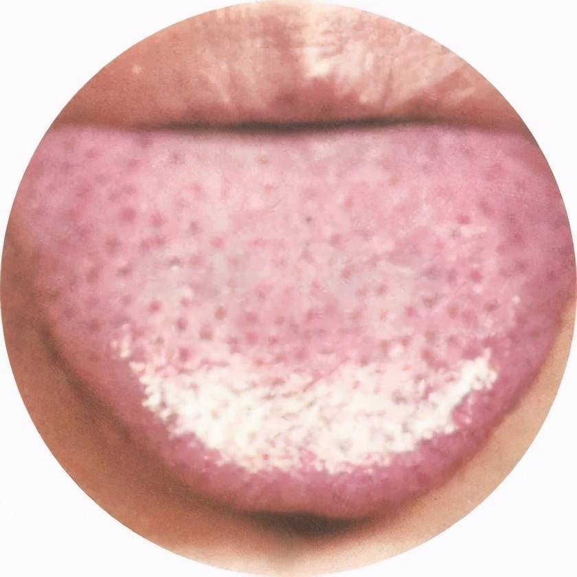 舌质:紫暗 舌苔:白腻苔 舌体:正常 此舌象患者或伴有抑郁烦闷,腹胀