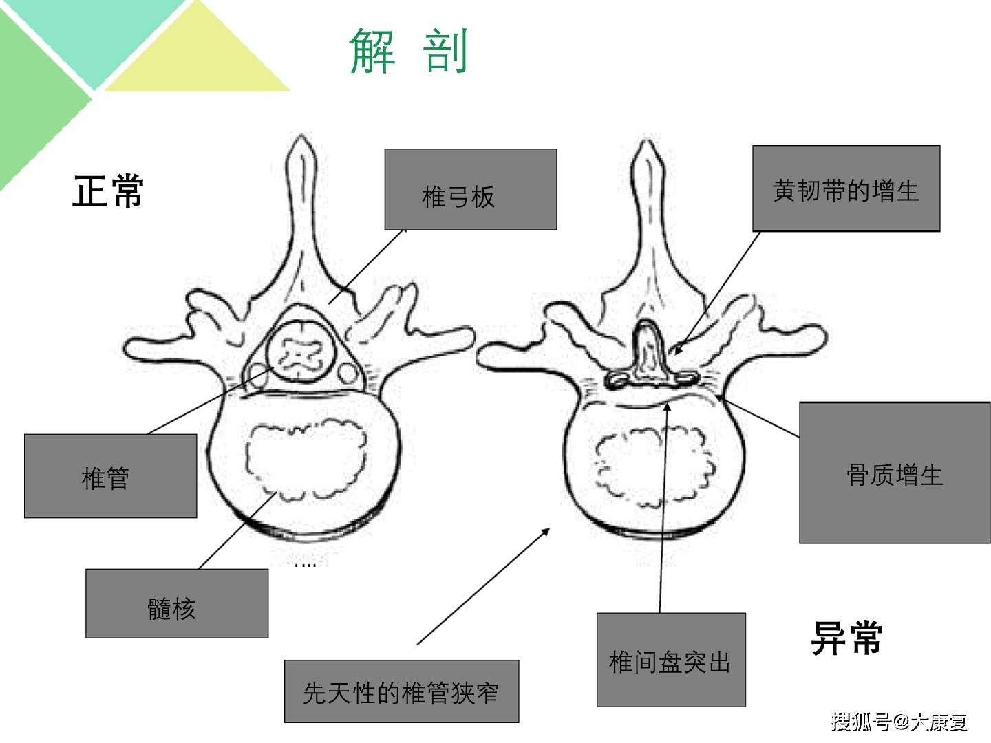 腰椎管狭窄症病人的护理