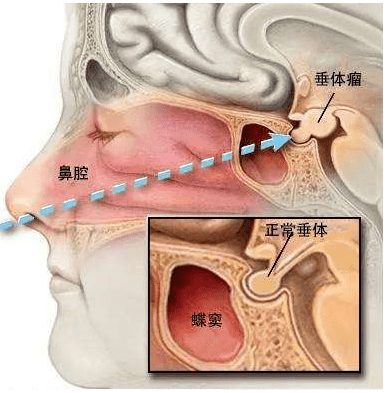 "釜底抽薪",鼻腔入路巧治脑垂体瘤!