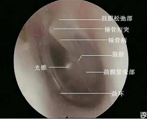 掏耳朵这等小事的风险,你承受不起!