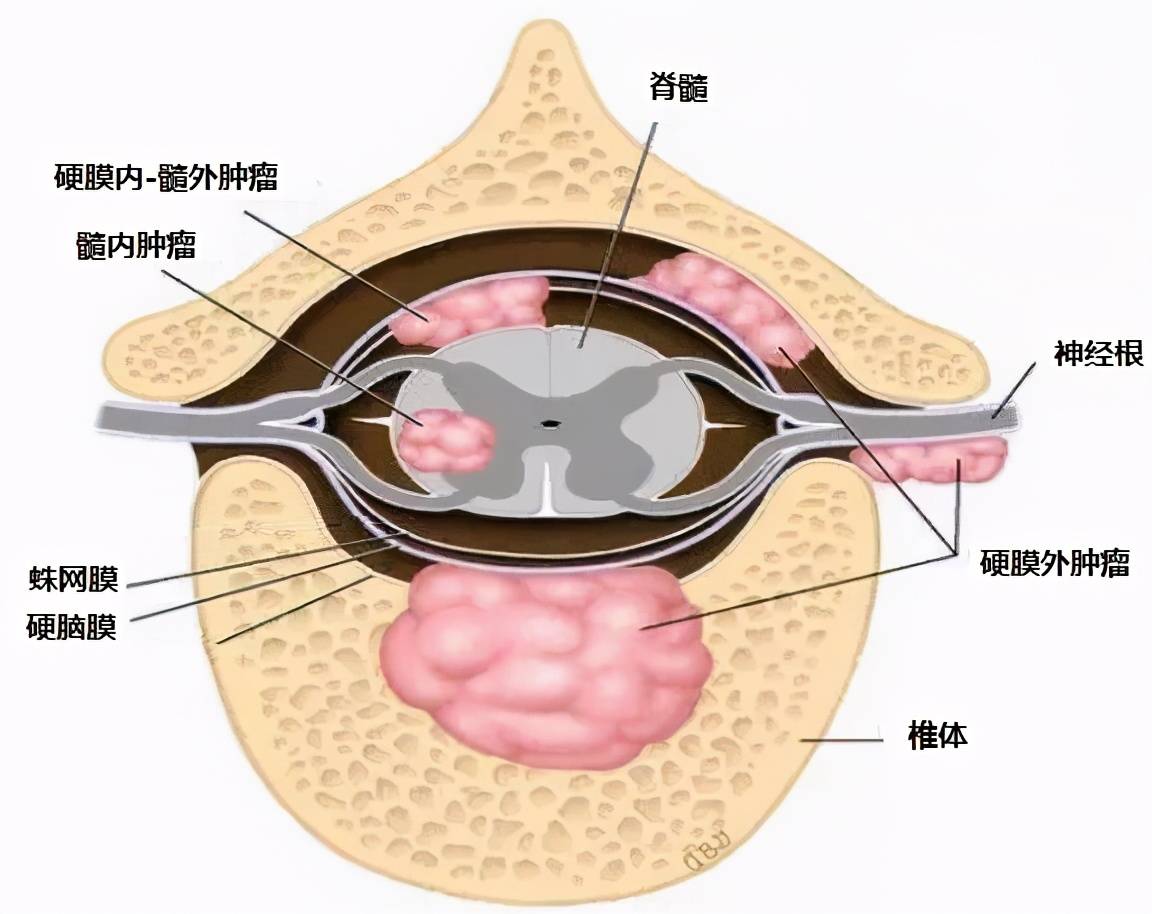 椎管内脊膜瘤是怎么回事