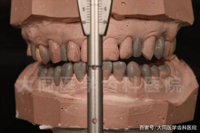 重建全口咬合关系,前牙设计贴面数字化美学修复,改善前牙颜色及形态